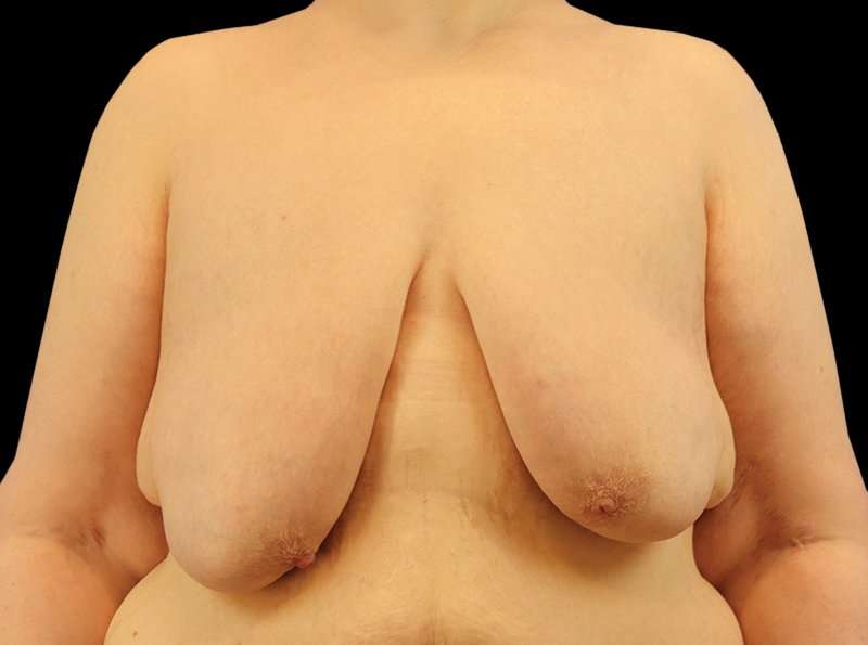 Female To Male Breast Before & After Patient #3966