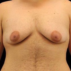 Female To Male Breast Before & After Patient #3977