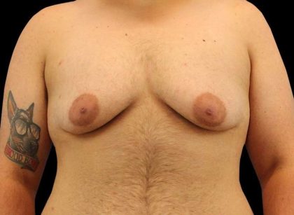 Female To Male Breast Before & After Patient #3977