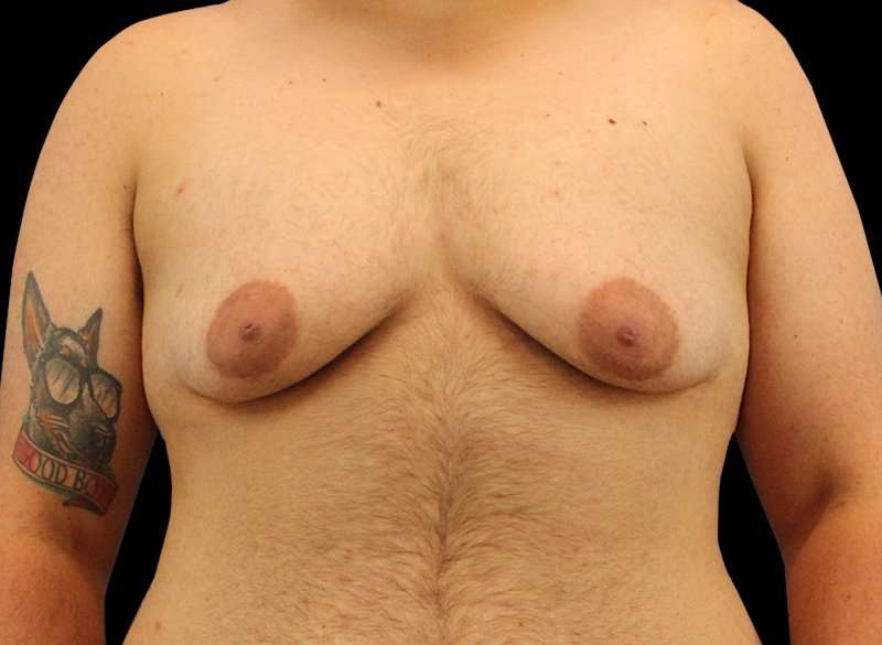Female To Male Breast Before & After Patient #3977