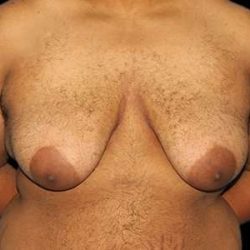 Female To Male Breast Before & After Patient #3984