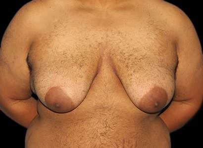Female To Male Breast Before & After Patient #3984