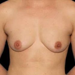 Female To Male Breast Before & After Patient #3991