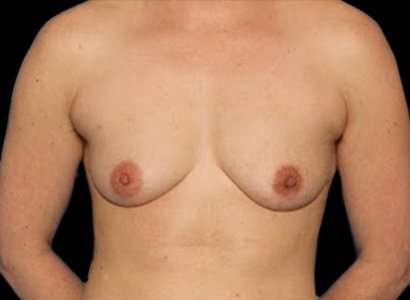 Female To Male Breast Before & After Patient #3991
