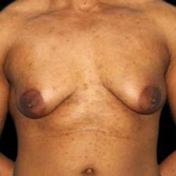 Female To Male Breast Before & After Patient #3998
