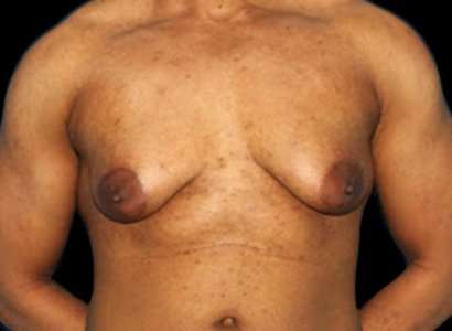Female To Male Breast Before & After Patient #3998