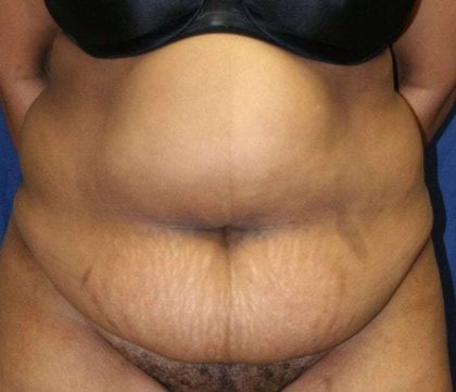 Abdominoplasty (Tummy Tuck) Before & After Patient #920