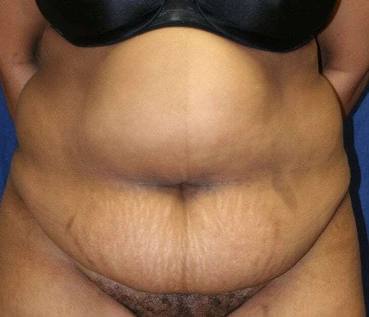 Abdominoplasty (Tummy Tuck) Before & After Patient #920
