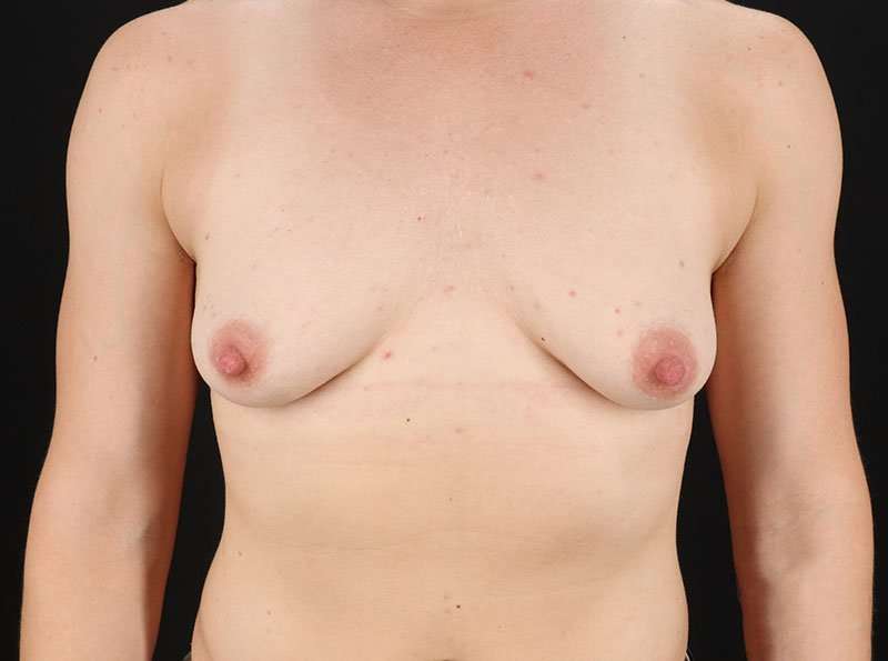 Female To Male Breast Before & After Patient #4009