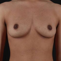 Female To Male Breast Before & After Patient #4020