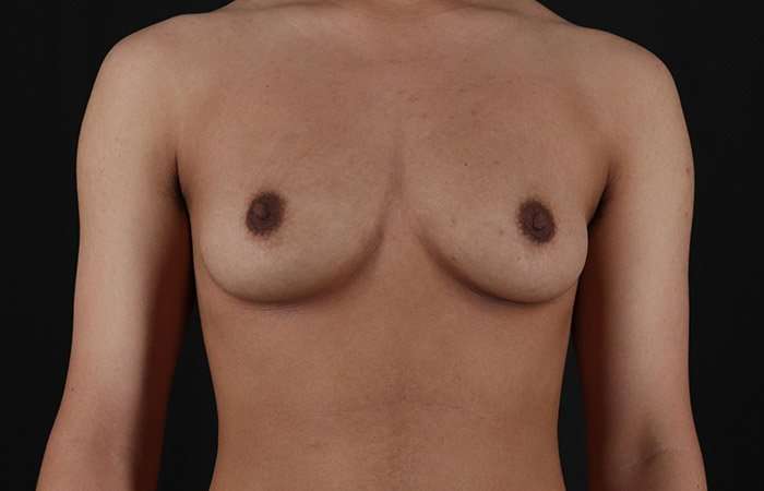 Female To Male Breast Before & After Patient #4020