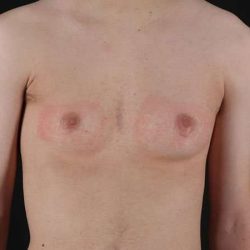Female To Male Breast Before & After Patient #4031