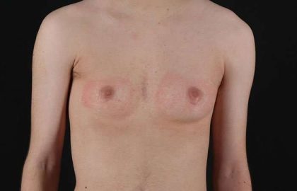 Female To Male Breast Before & After Patient #4031