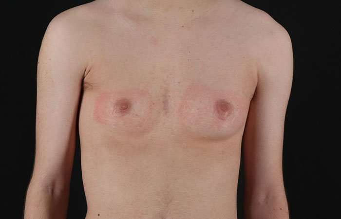 Female To Male Breast Before & After Patient #4031