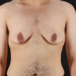 Female To Male Breast Before & After Patient #4042