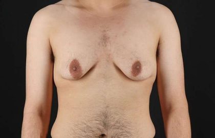 Female To Male Breast Before & After Patient #4042
