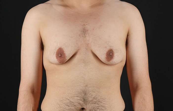 Female To Male Breast Before & After Patient #4042