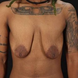 Female To Male Breast Before & After Patient #4053