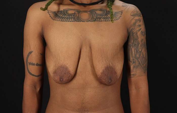 Female To Male Breast Before & After Patient #4053