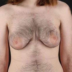 Female To Male Breast Before & After Patient #4075
