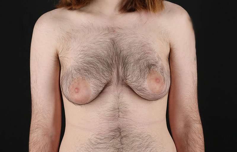 Female To Male Breast Before & After Patient #4075