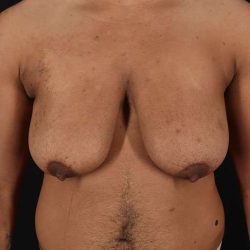 Female To Male Breast Before & After Patient #4086
