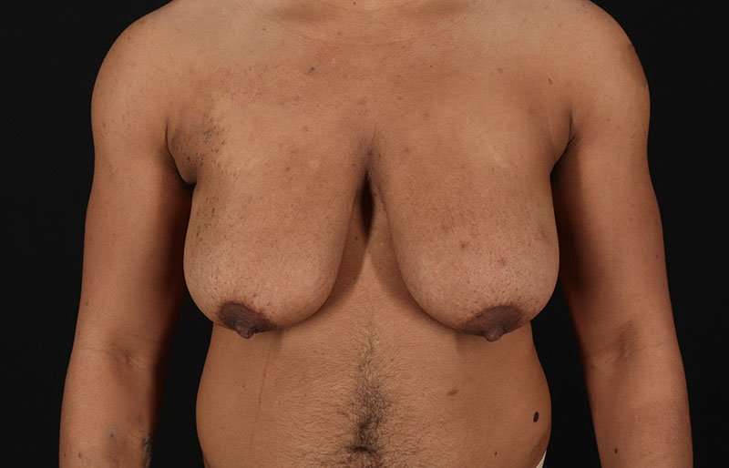Female To Male Breast Before & After Patient #4086