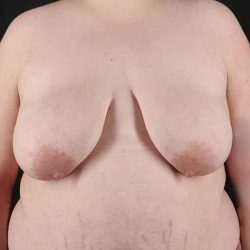 Female To Male Breast Before & After Patient #4097