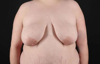 Female To Male Breast Before & After Patient #4097