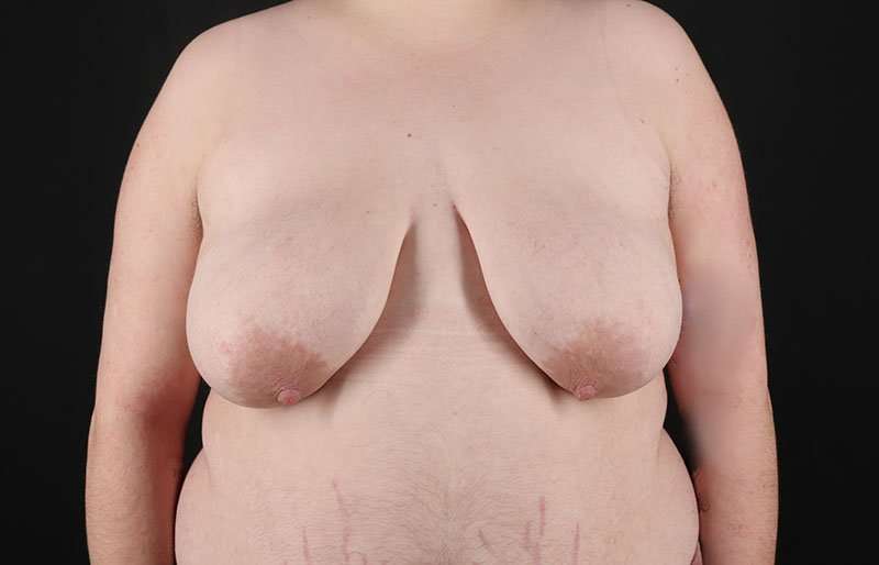 Female To Male Breast Before & After Patient #4097
