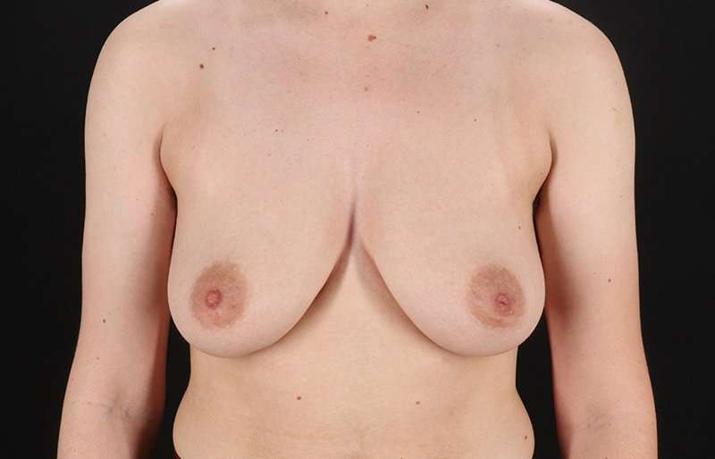 Female To Male Breast Before & After Patient #4108