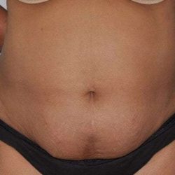 Abdominoplasty (Tummy Tuck) Before & After Patient #928