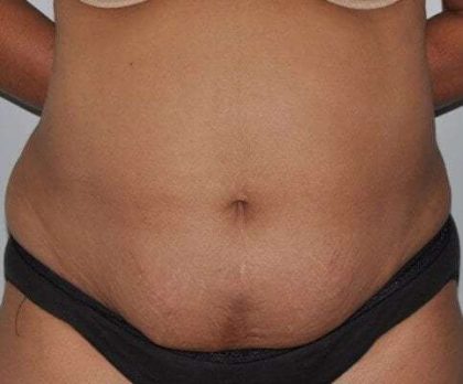 Abdominoplasty (Tummy Tuck) Before & After Patient #928