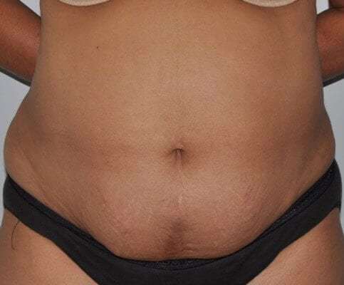 Abdominoplasty (Tummy Tuck) Before & After Patient #928