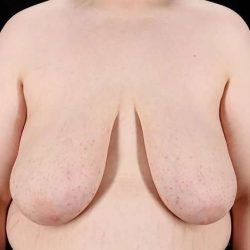 Female To Male Breast Before & After Patient #4130