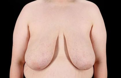 Female To Male Breast Before & After Patient #4130