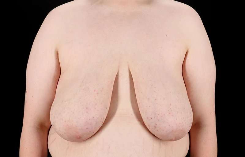 Female To Male Breast Before & After Patient #4130