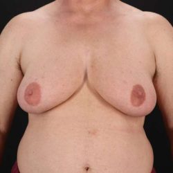 Female To Male Breast Before & After Patient #4152