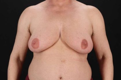 Female To Male Breast Before & After Patient #4152