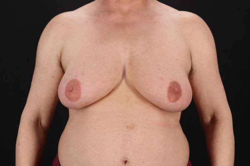 Female To Male Breast Before & After Patient #4152