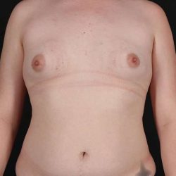 Female To Male Breast Before & After Patient #4163