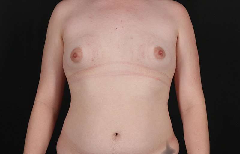 Female To Male Breast Before & After Patient #4163