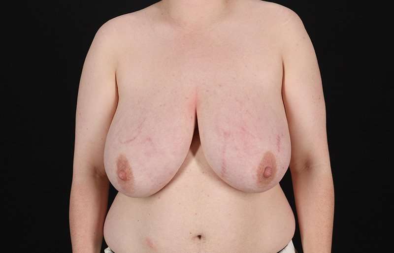 Female To Male Breast Before & After Patient #4174