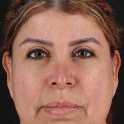 Fat Grafting To The Face Before & After Patient #4188