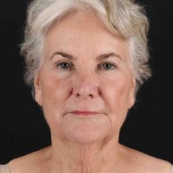 Fat Grafting To The Face Before & After Patient #4221