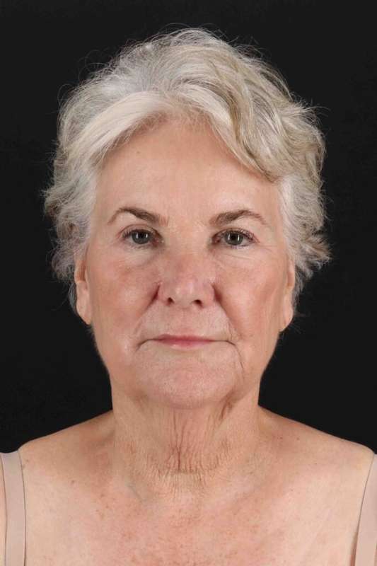 Fat Grafting To The Face Before & After Patient #4221