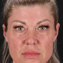 Fat Grafting To The Face Before & After Patient #4232