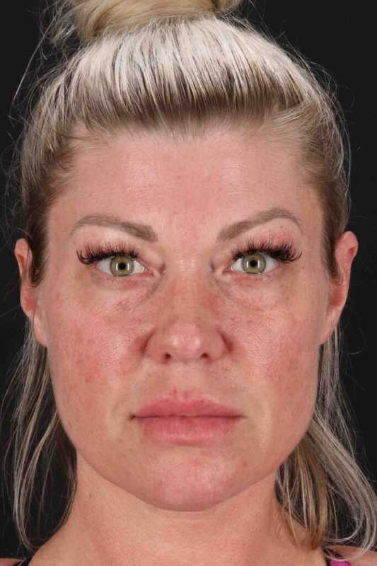 Fat Grafting To The Face Before & After Patient #4232
