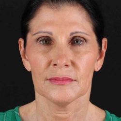 Fat Grafting To The Face Before & After Patient #4254