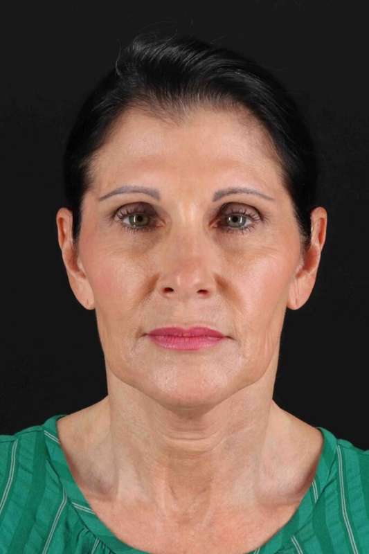 Fat Grafting To The Face Before & After Patient #4254